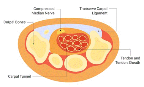 Placeholder: Carpal tunnel anatomy diagram showing median nerve compression